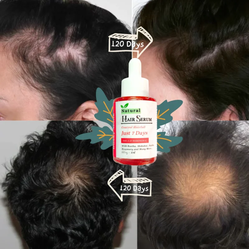 Witness noticeable hair regrowth on the scalp after 120 days of using Dusky Monk Hair Care Solutions, showcasing the effectiveness of the product in promoting scalp health and revitalizing hair growth